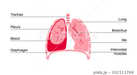 Hemothorax medical poster 102111768