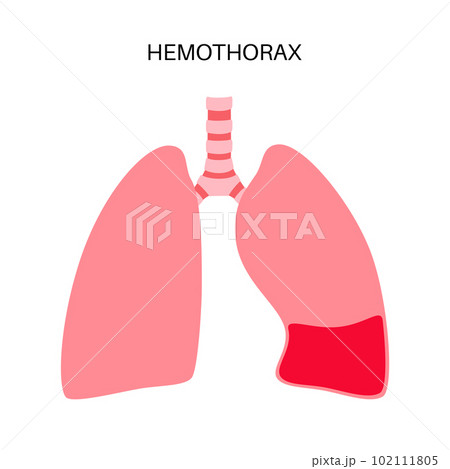 Hemothorax medical poster Hemothorax medical poster 102111805