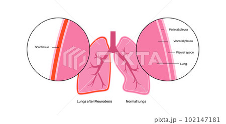 Pleurodesis medical procedure 102147181
