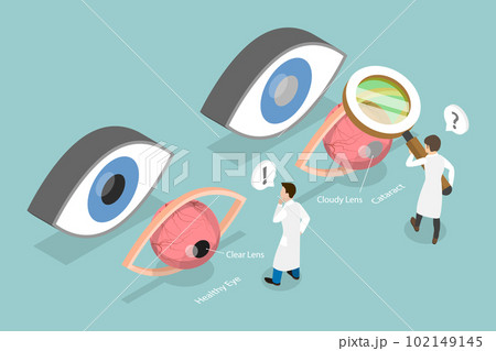 3D Isometric Flat Vector Conceptual Illustration of Cataract 3D Isometric Flat Vector Conceptual Illustration of Cataract 102149145