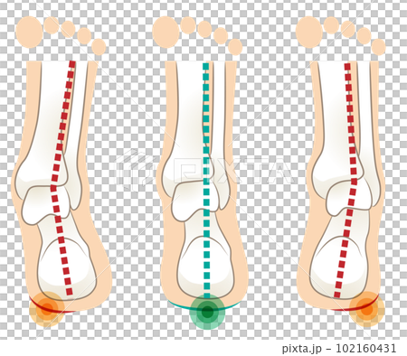 從後面看右腳跟骨和腳後跟的傾斜度 102160431