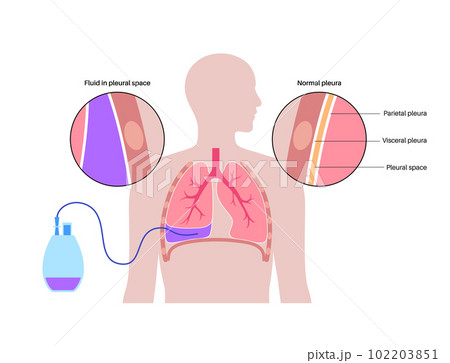Tunneled pleural catheter 102203851