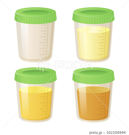 Pee in a plastic container set. Collection of Urine Analysis Vials in Various Colors from Clear to Yellow - Flat Cartoon Style Vector Illustration isolated on white background. 102208994