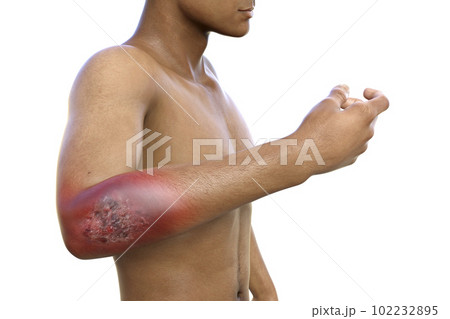 Protothecosis infection on human arm, 3D illustration 102232895