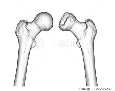 Femur bone affected by Legg-Calve-Perthes Disease, a childhood hip disorder, 3D illustration 102233231