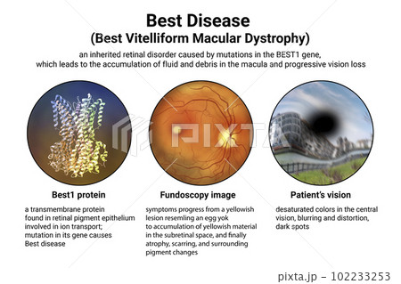 Best vitelliform macular dystrophy, 3D illustration Best vitelliform macular dystrophy, 3D illustration 102233253