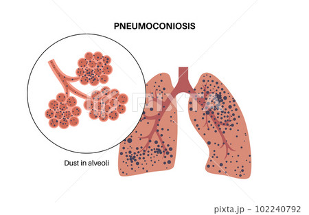Pneumoconiosis lung disease Pneumoconiosis lung disease 102240792
