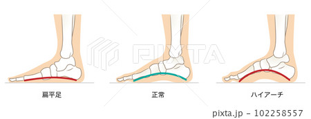 足のアーチの正常と異常 102258557