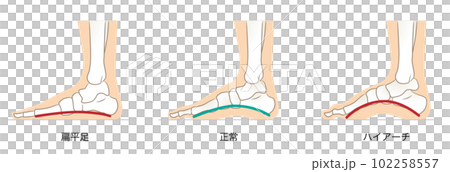 足のアーチの正常と異常 102258557
