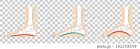 Normal and abnormal foot arches Normal and abnormal foot arches 102258559