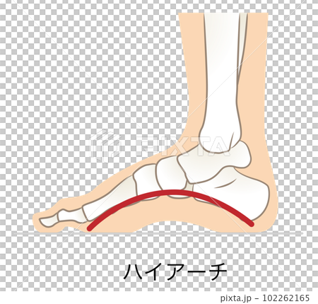 足弓太高,足弓高 102262165