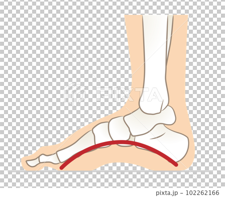 Feet with too high arches, feet with high arches 102262166