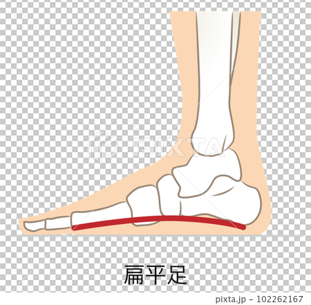 Feet without arches, feet with flat feet 102262167