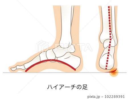 ハイアーチの足の側面と後ろ面 102289391