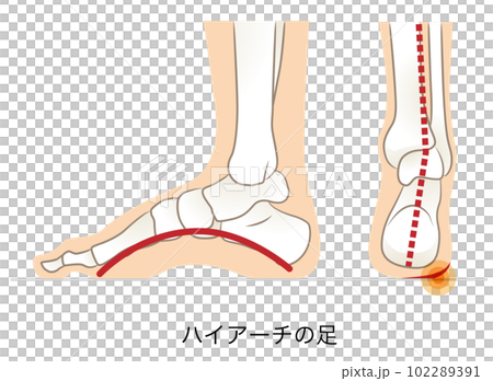 Side and back of high arch foot Side and back of high arch foot 102289391