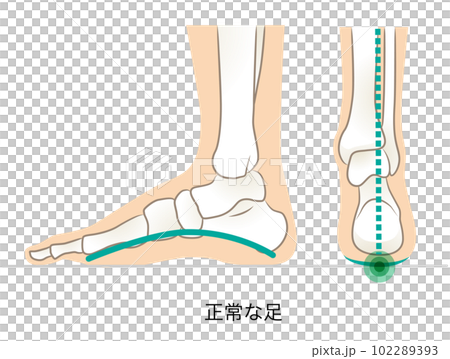 正常足弓足的外側和後部 102289393