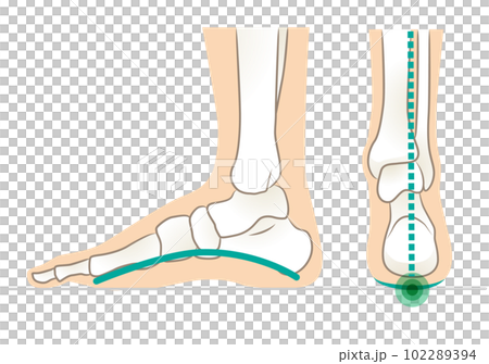 Lateral and posterior aspect of foot with normal arch Lateral and posterior aspect of foot with normal arch 102289394