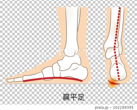 Lateral and posterior aspects of flat feet Lateral and posterior aspects of flat feet 102289395