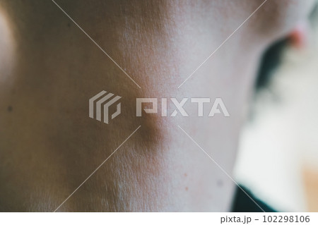 喉仏付近の吹き出物 102298106