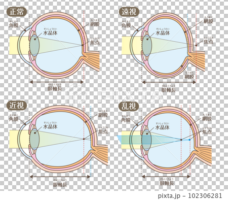 Eye structure_Visual acuity (myopia, hyperopia, astigmatism) 102306281