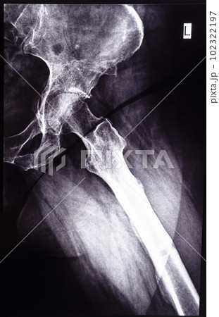 negative x-ray side view of acetabular cavity 102322197