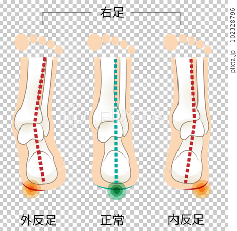 從後面看右腳跟骨和腳後跟的傾斜度 102328796