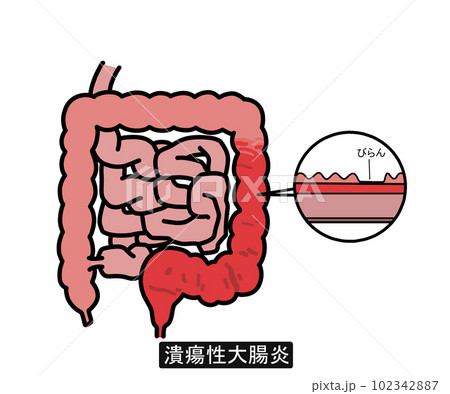 潰瘍性大腸炎(文字あり) 潰瘍性大腸炎(文字あり) 102342887