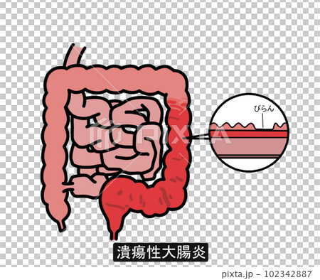 潰瘍性大腸炎(文字あり) 潰瘍性大腸炎(文字あり) 102342887