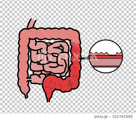 Ulcerative colitis (no letters) 102342888