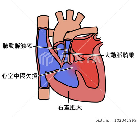 ファロー四徴症 102342895