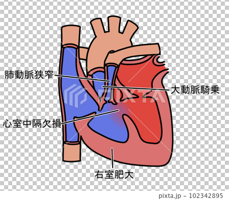 ファロー四徴症 102342895