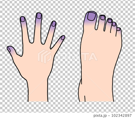 cyanosis cyanosis 102342897