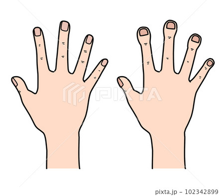 ばち状指 102342899