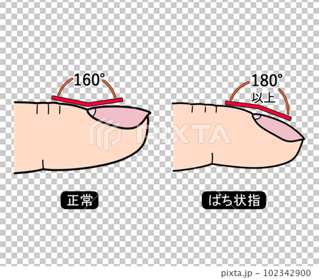 ばち状指（文字あり） 102342900