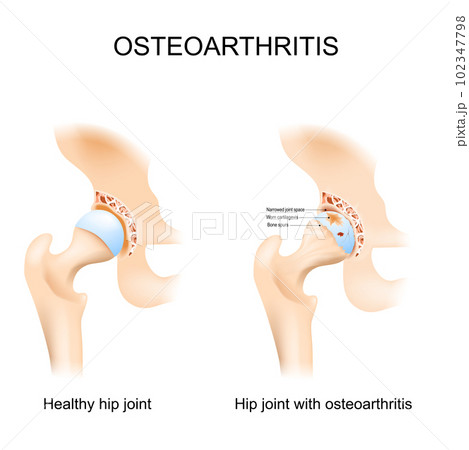 Hip joint with osteoarthritis Hip joint with osteoarthritis 102347798