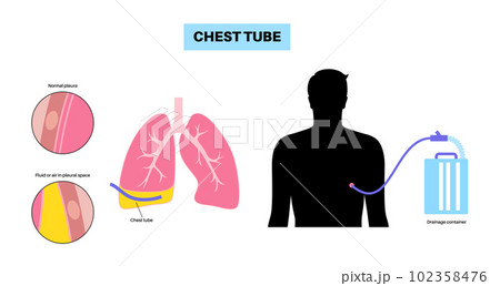 Chest tube catheter Chest tube catheter 102358476