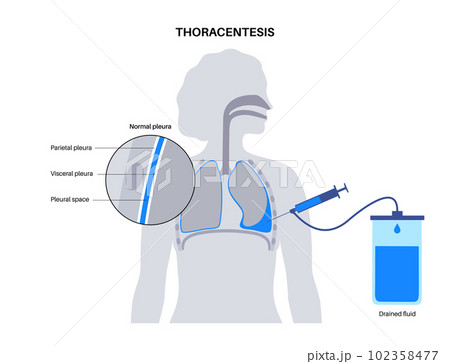 Thoracentesis medical procedure 102358477
