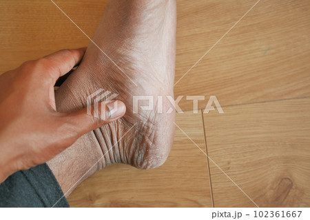 Close up on young man suffering feet pain  102361667