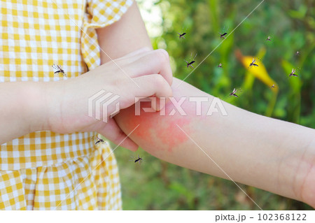 Little girl has skin rash allergy and itchy on her arm from mosquito bite 102368122