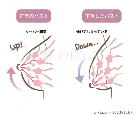 ハリのあるバストと垂れたバストのイラスト ビフォアアフター ハリのあるバストと垂れたバストのイラスト ビフォアアフター 102381167