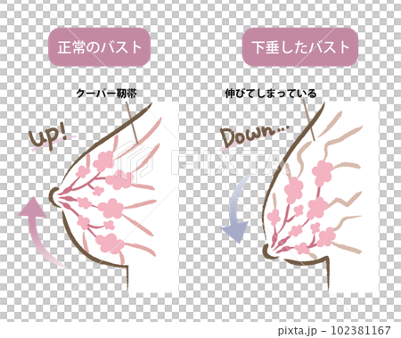 ハリのあるバストと垂れたバストのイラスト ビフォアアフター ハリのあるバストと垂れたバストのイラスト ビフォアアフター 102381167