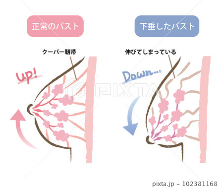 ハリのあるバストと垂れたバストのイラスト　ビフォアアフター 102381168
