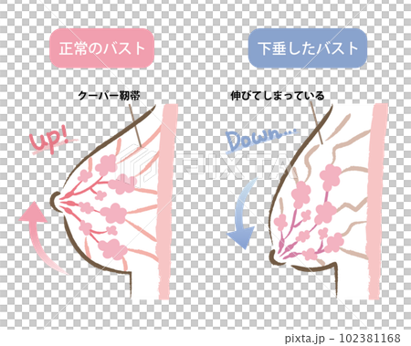 ハリのあるバストと垂れたバストのイラスト　ビフォアアフター 102381168
