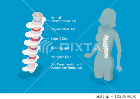 3D Isometric Flat Vector Conceptual Illustration of Degenerative Disc Disease 102394050