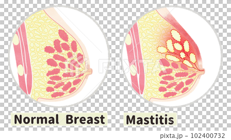 健康女性乳房與乳腺炎的比較英文插圖 健康女性乳房與乳腺炎的比較英文插圖 102400732