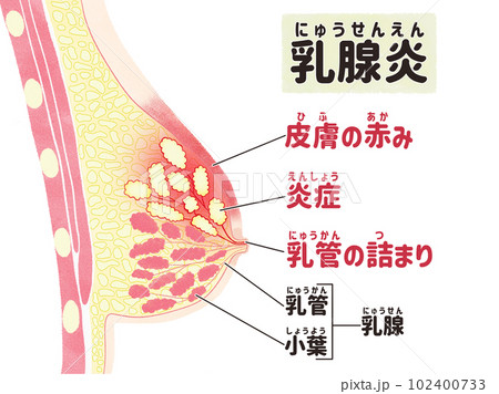 乳腺炎の症状 日本語の図解イラスト 乳腺炎の症状 日本語の図解イラスト 102400733