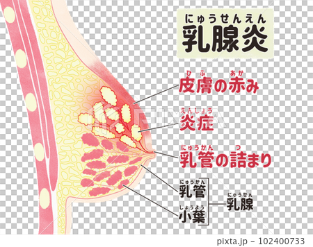 乳腺炎の症状 日本語の図解イラスト 乳腺炎の症状 日本語の図解イラスト 102400733
