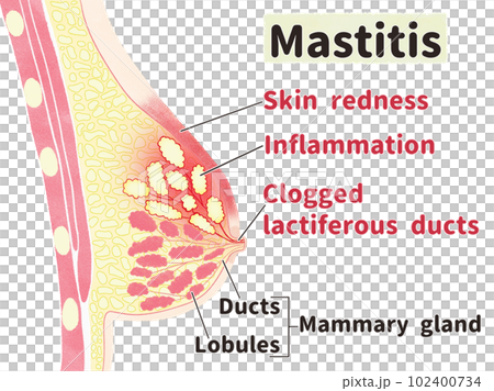 乳腺炎的症狀英文插圖 乳腺炎的症狀英文插圖 102400734