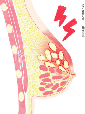 乳腺炎の人体断面図のイラスト 乳腺炎の人体断面図のイラスト 102400735