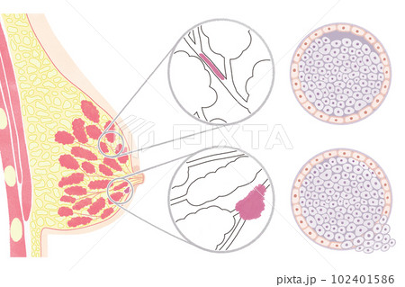 非浸潤性乳管がん（DCIS）と浸潤性乳管がん（IDC）の図解イラストのイラスト素材 [102401586] - PIXTA